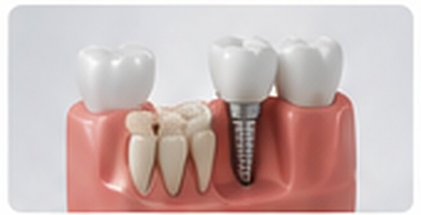 Dental implant illustration for the AMDC dental implant cost guide in Lahore