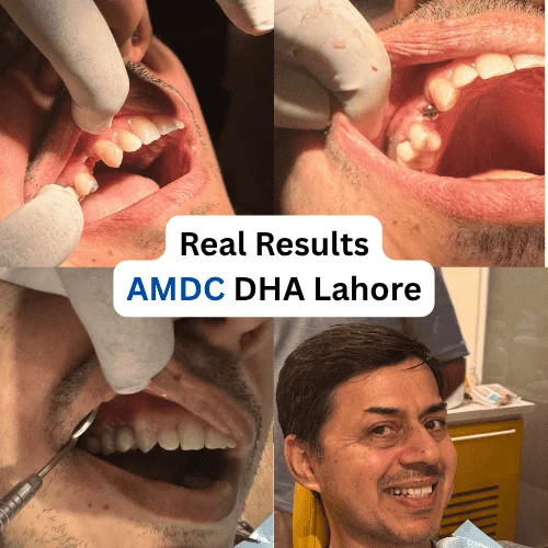 Real dental implant treatment result at Al Mairaj Dental & Cosmetics (AMDC) in DHA Lahore