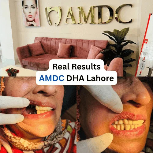 Real smile restoration result at Al Mairaj Dental & Cosmetics (AMDC) in DHA Lahore