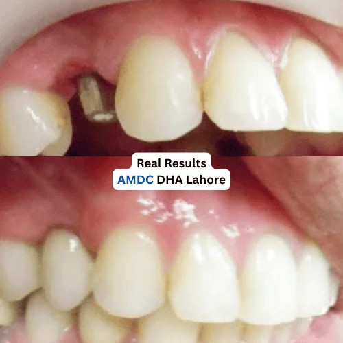 Before and after missing tooth implant restoration result at Al Mairaj Dental & Cosmetics (AMDC)