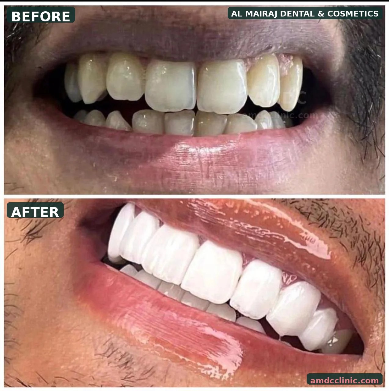 Dental veneers before and after at AMDC Lahore