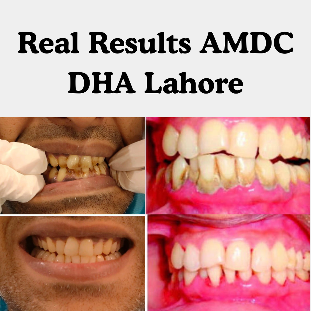 scaling polishing results