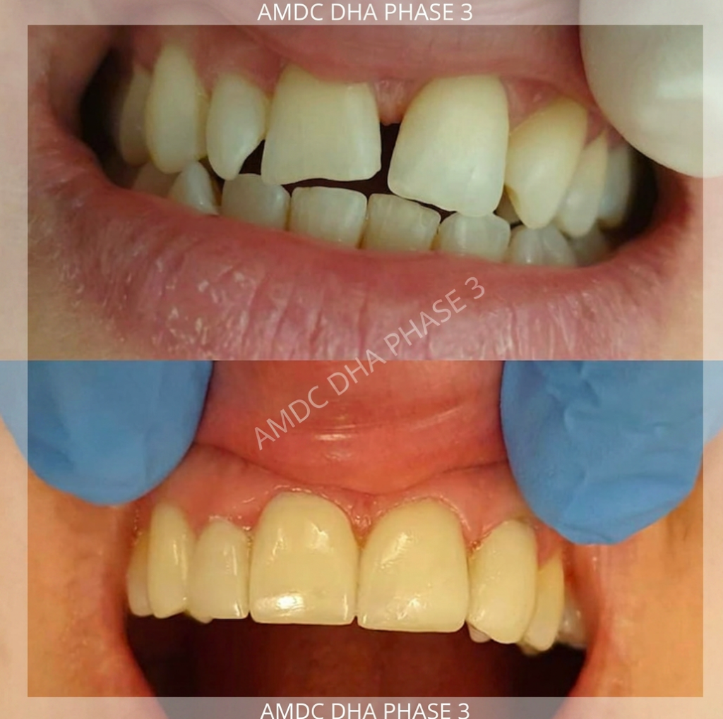 Before and after zirconia crown smile transformation - AMDC DHA Lahore