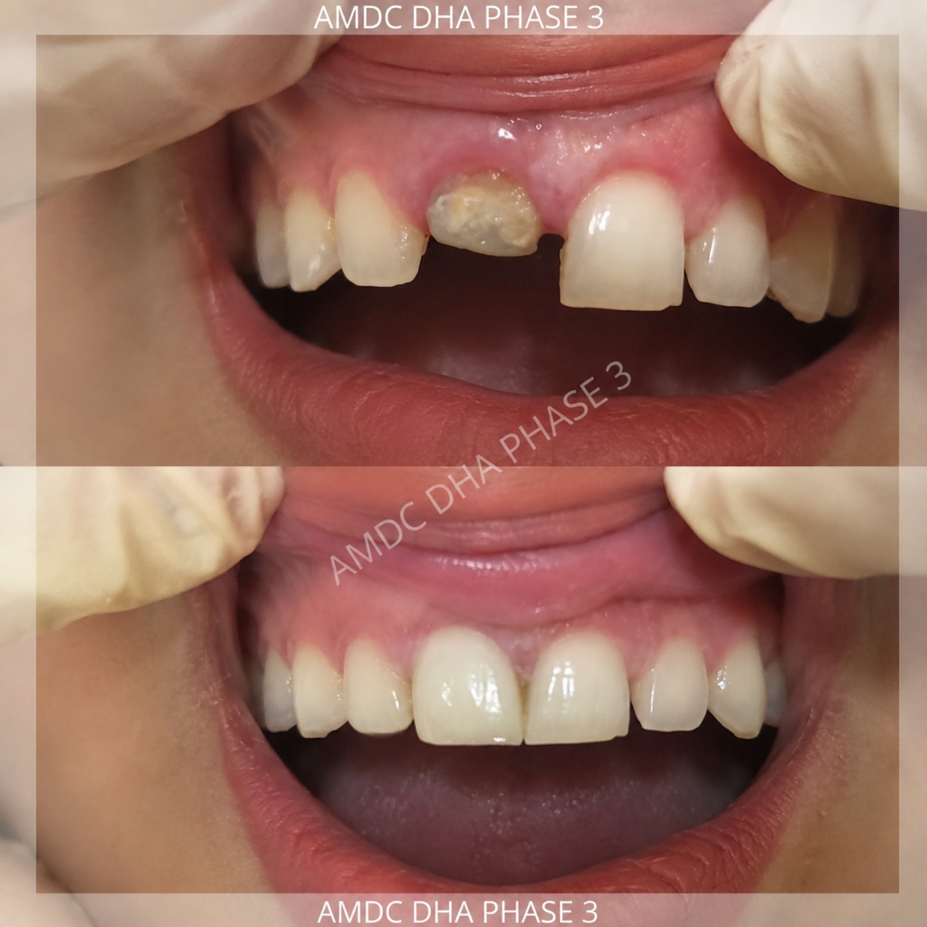 Zirconia crown on front tooth before and after - AMDC DHA Lahore